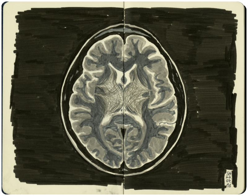 Magnetresonanztomografie vom Gehirn